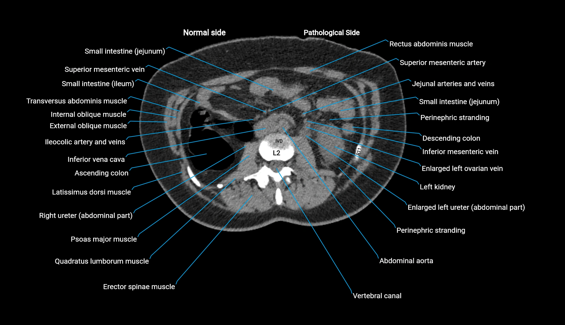CT KUB axial cross sectional anatomy  radiology image -img-00201-00061.webp